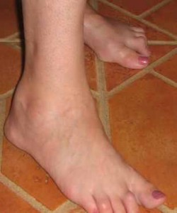 Rheumatoid-Arthritis-Swelling-Toes