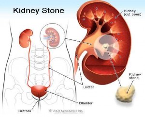 kidney_stone