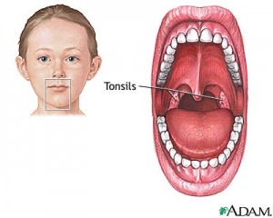 tonsillectomy-series