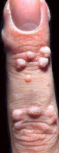 picture-of-wart-on-finger