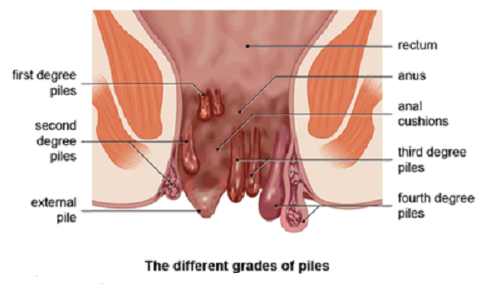 Piles-or-Haemorrhoids